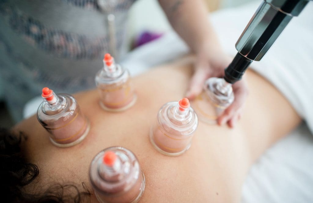 Cupping treatment