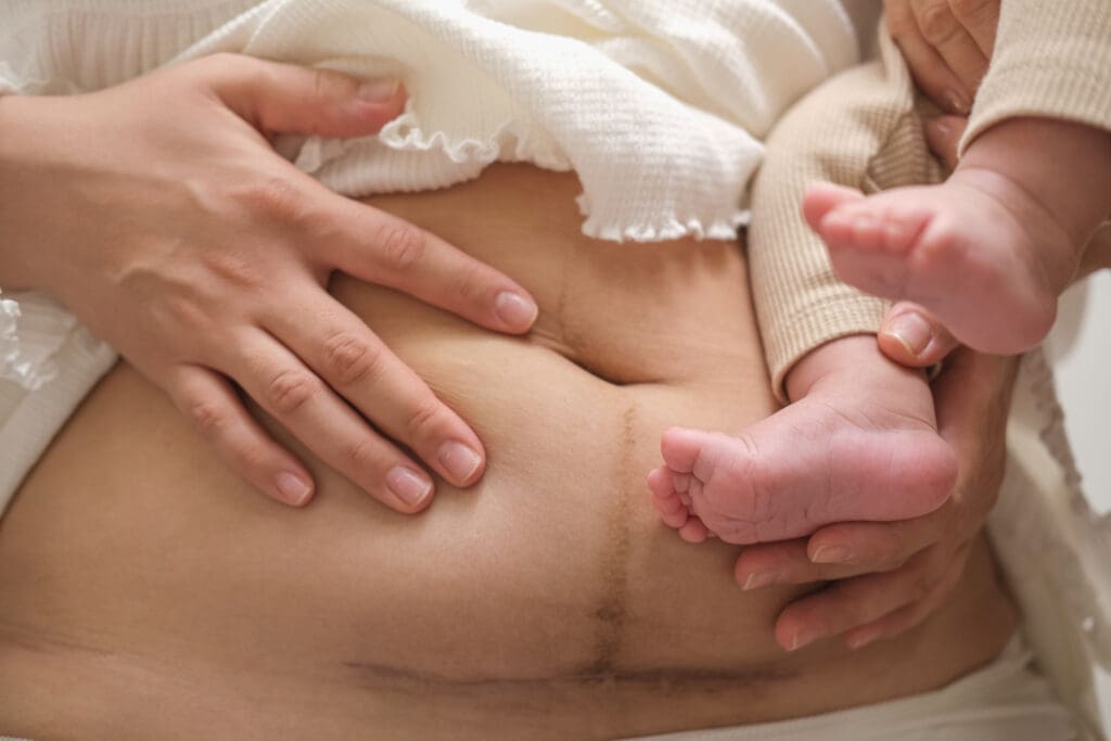 massage for c-section
